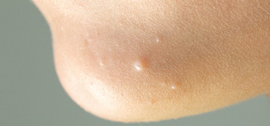 Спасаемся от контагиозного моллюска: симптомы, как не заболеть, лечится ли