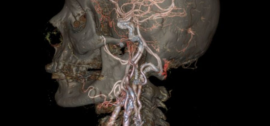 КТ сосудов головы как современный и точный метод диагностики