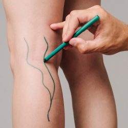 Хирург объяснил, в чем главная опасность тромбоза