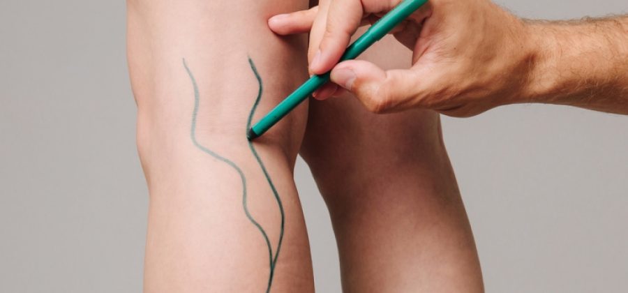 Хирург объяснил, в чем главная опасность тромбоза