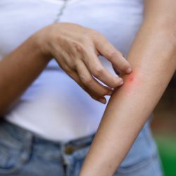 Врач назвал самый распространенный вид аллергии