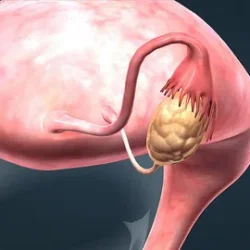 Лечение кисты яичника: современные подходы к сохранению женского здоровья