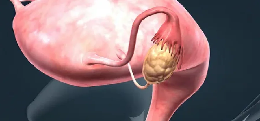 Лечение кисты яичника: современные подходы к сохранению женского здоровья