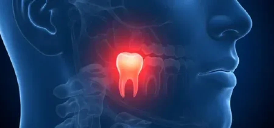 Удаление зубов мудрости как важный шаг к сохранению здоровья полости рта