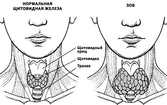 эндемический зоб щитовидной железы 