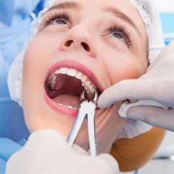 Идет кровь после удаления зуба – как ее остановить?