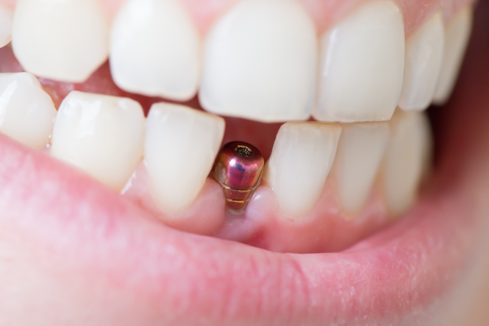 плюсы и минусы зубных имплантов как решиться на процедуру