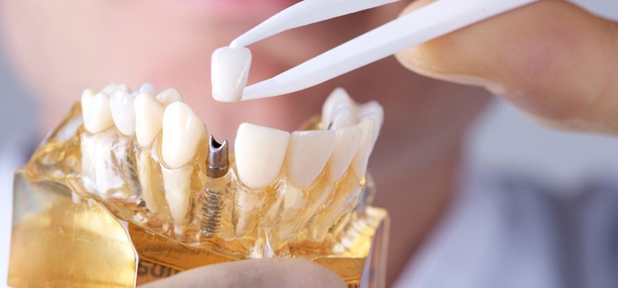 Вживлённые зубы – удобно это или нет?