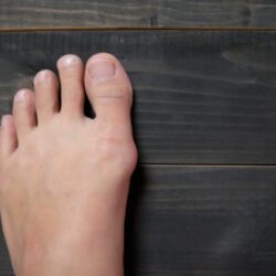 11 способов избавиться от косточки на большом пальце ноги
