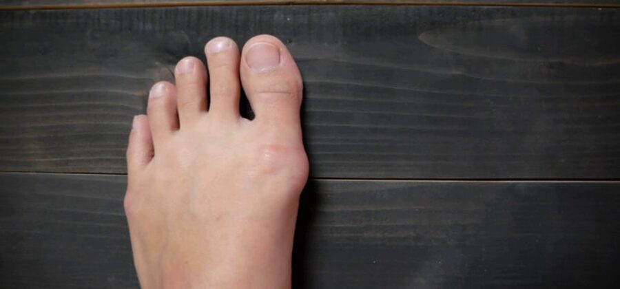 11 способов избавиться от косточки на большом пальце ноги